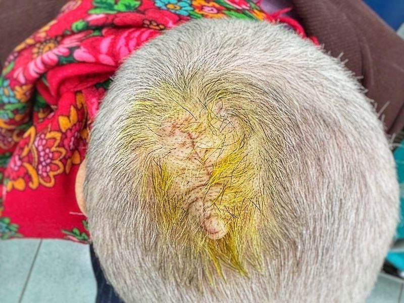 Врачи удалили 90-летней женщине кисту, с которой она жила 30 лет