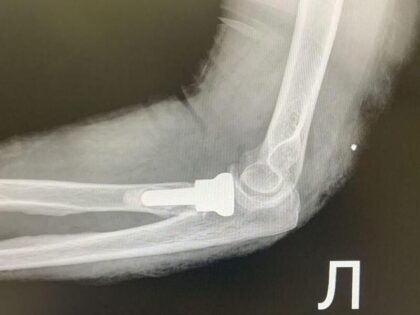 Эндопротезирование локтя в Наро-Фоминске: как проводят редкие операции