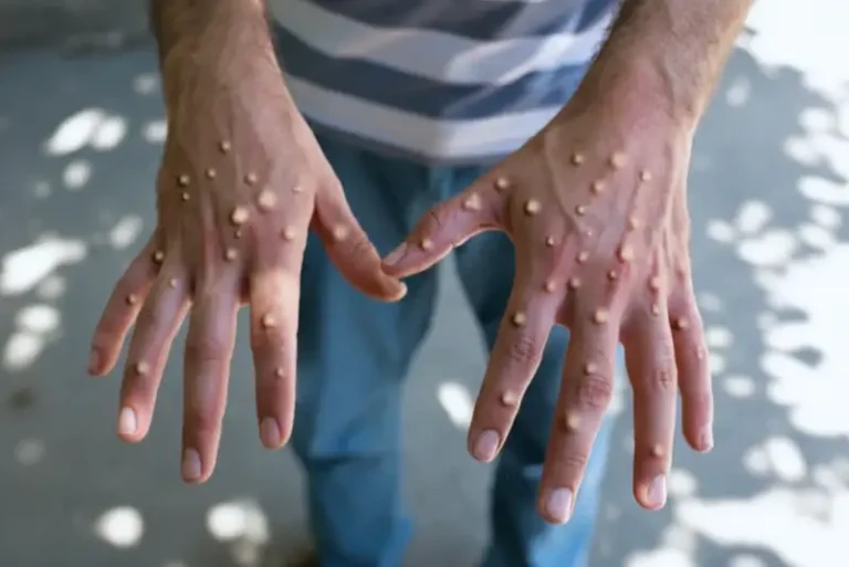 Оспа обезьян в Подмосковье: симптомы и профилактика